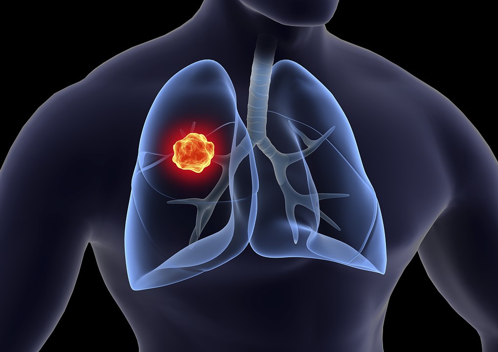 非小细胞肺癌免疫治疗，PD-L1 如何规范检测？